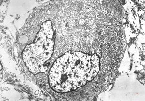 M,29y. | embryonal rhabdomyosyrcoma in testicular teratoma